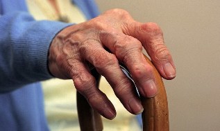 Arthrite et arthrose des doigts chez une personne âgée. 