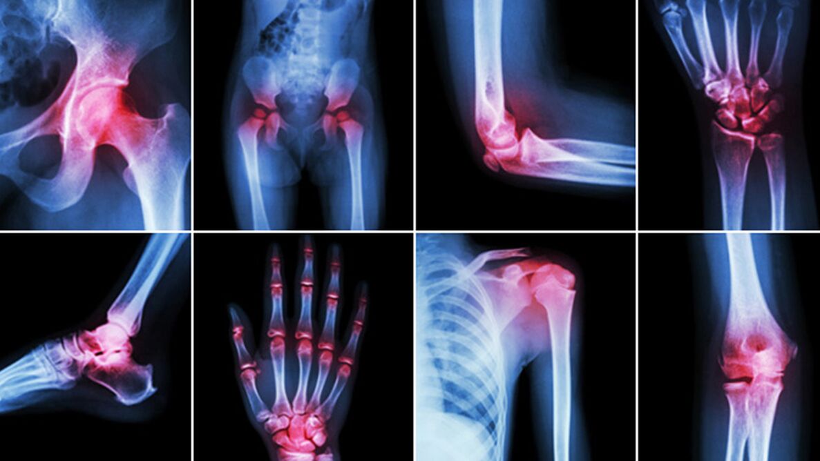 Radiographie des douleurs articulaires