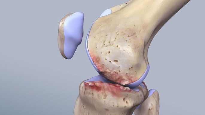 La structure de l'articulation du genou est affectée par la pathologie