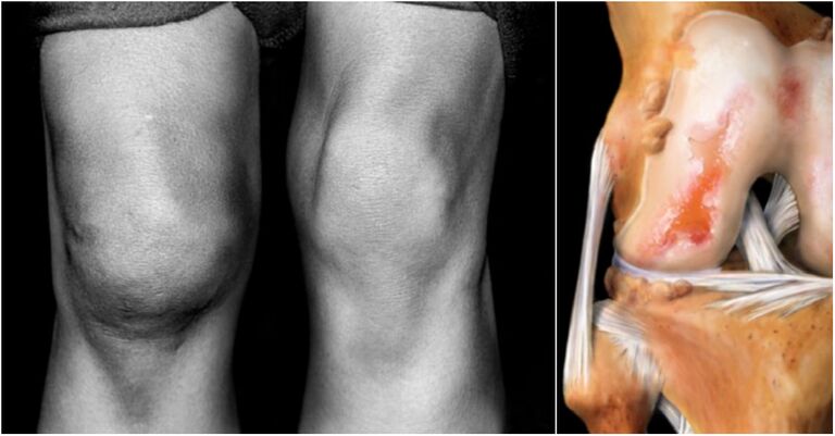 Ostéoarthrose de l'articulation du genou et l'articulation de la douleur