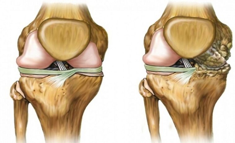 Sain et affecté par l'articulation de l'arthrose