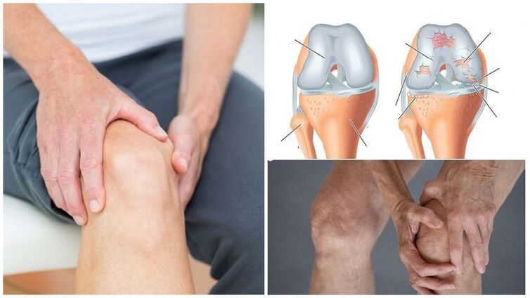 Symptôme de la douleur au genou pour l'arthrose de l'articulation du genou