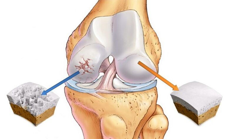 cartilage normal et arthrose