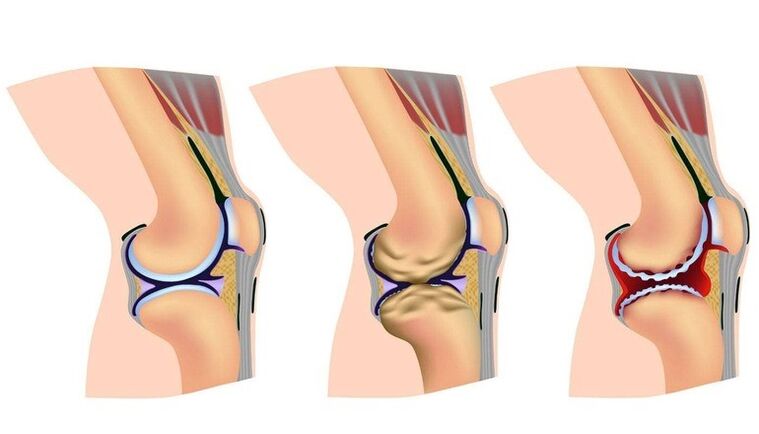 Étapes de déformation dans l'articulation du genou à l'arthrose