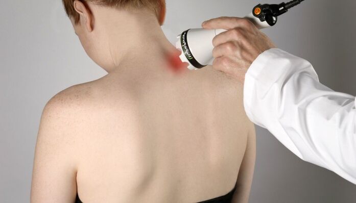 Thérapie au laser pour l'ostéochondrose cervicale