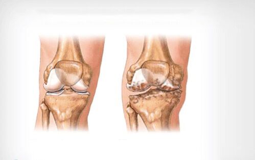 Arthrose de l'articulation du genou